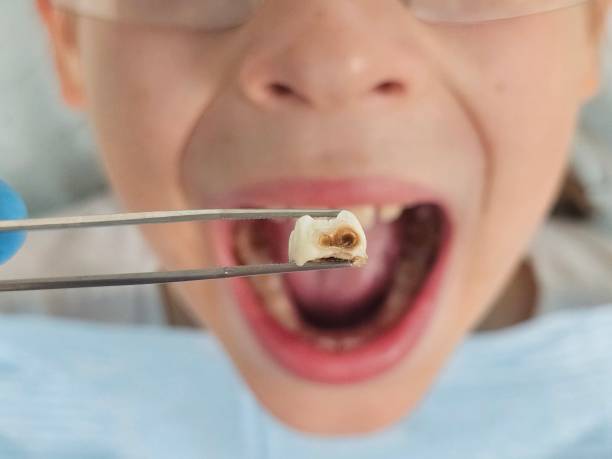Best Dental Abscess Treatment in Port Orchard, WA